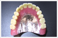 コバルトクロム床