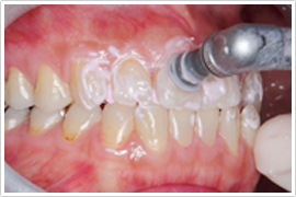 PMTCという歯のエステ