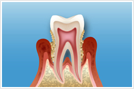 通常の歯磨きでは落とすことが難しいバイオフィルムを除去